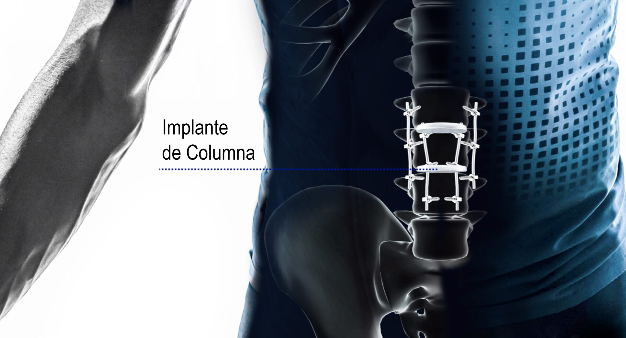 Los implantes médicos: una solución innovadora para mejorar la calidad de vida